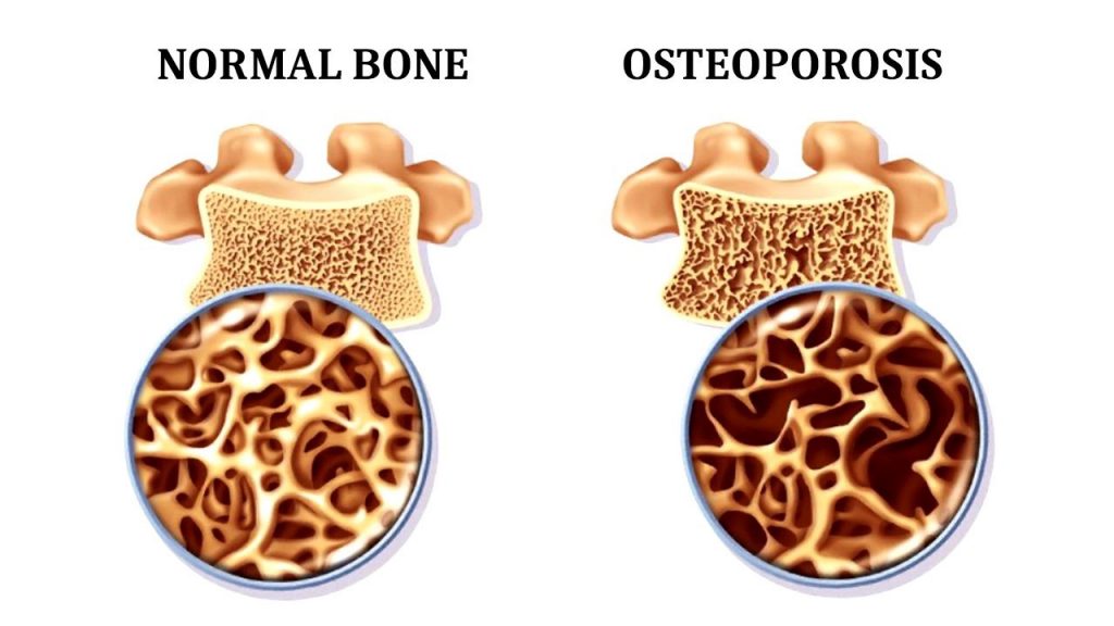 bone health