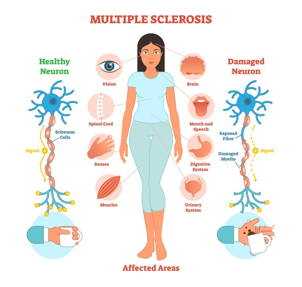 Multiple Sclerosis: from Fatigue to Strength 