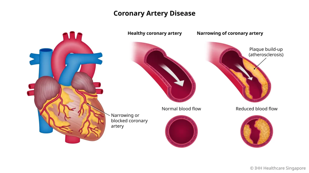 Coronary artery disease is a leading cause of death in Australia. Learn how exercise and an Exercise Physiologist can help reduce your cardiac risk.